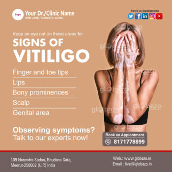 Signs Of Vitiligo-Health-79