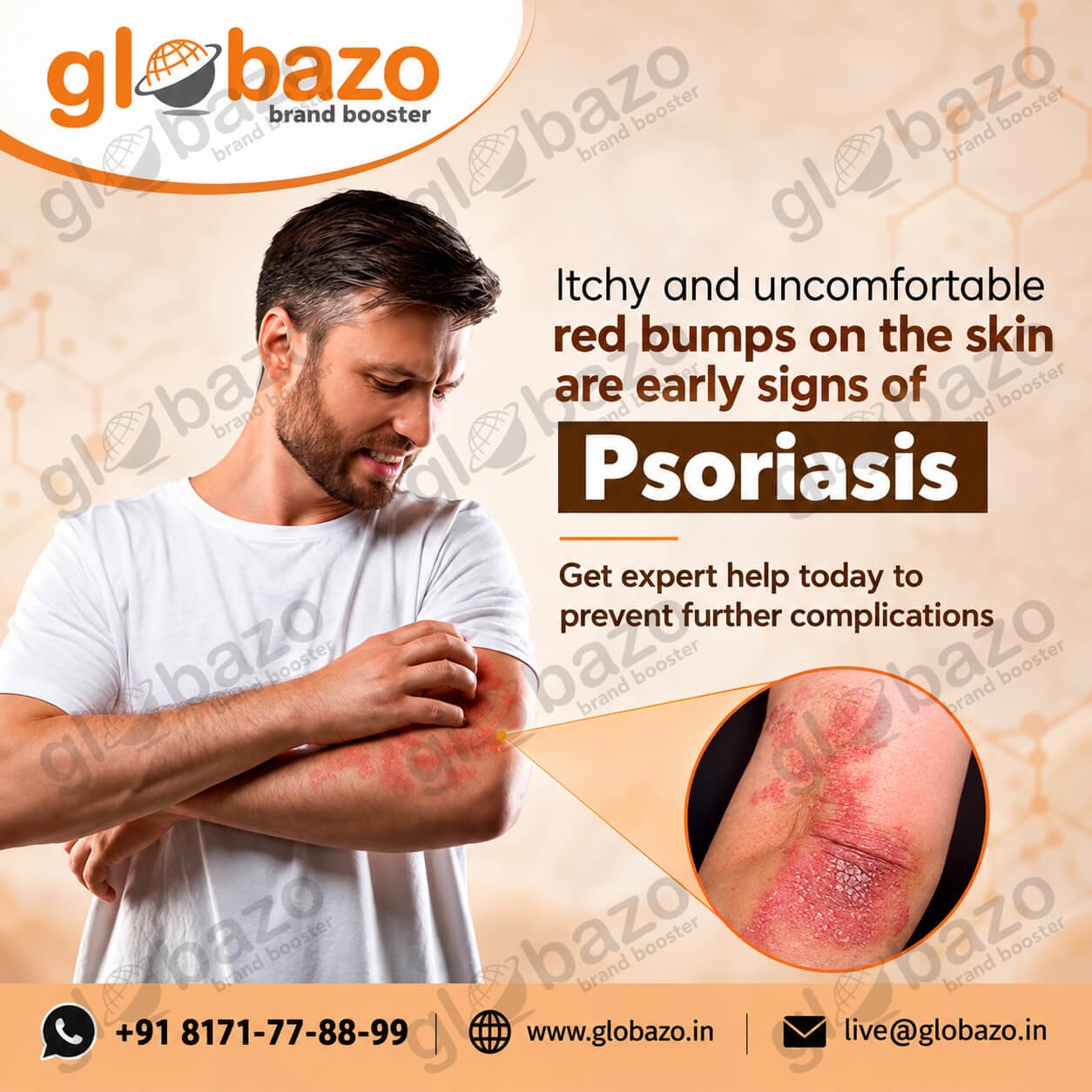 Psoriasis Treatment (Health-390)