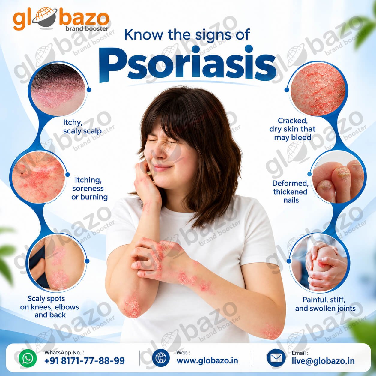 Psoriasis Signs (Health-392)