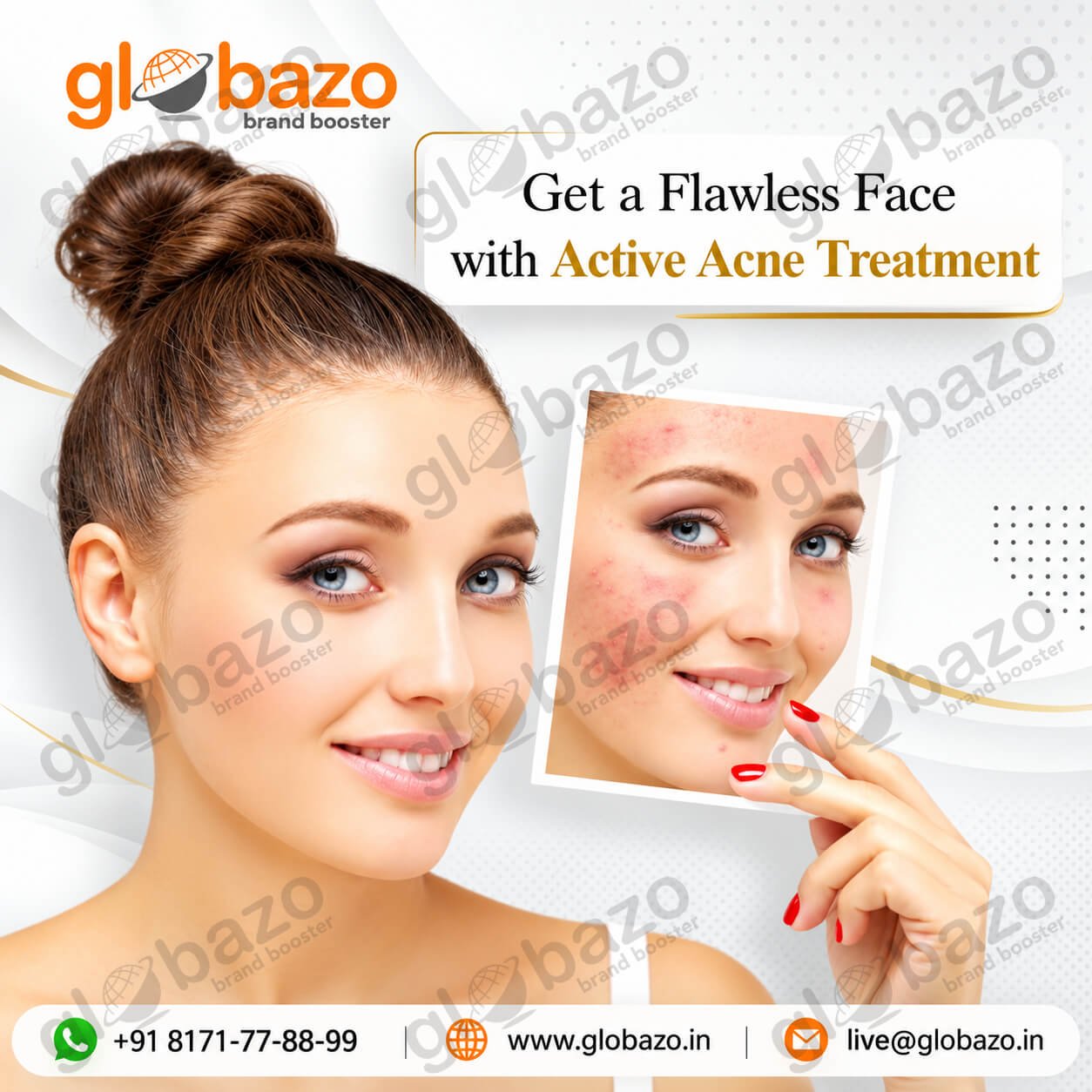 Acne Treatment (Health-394)