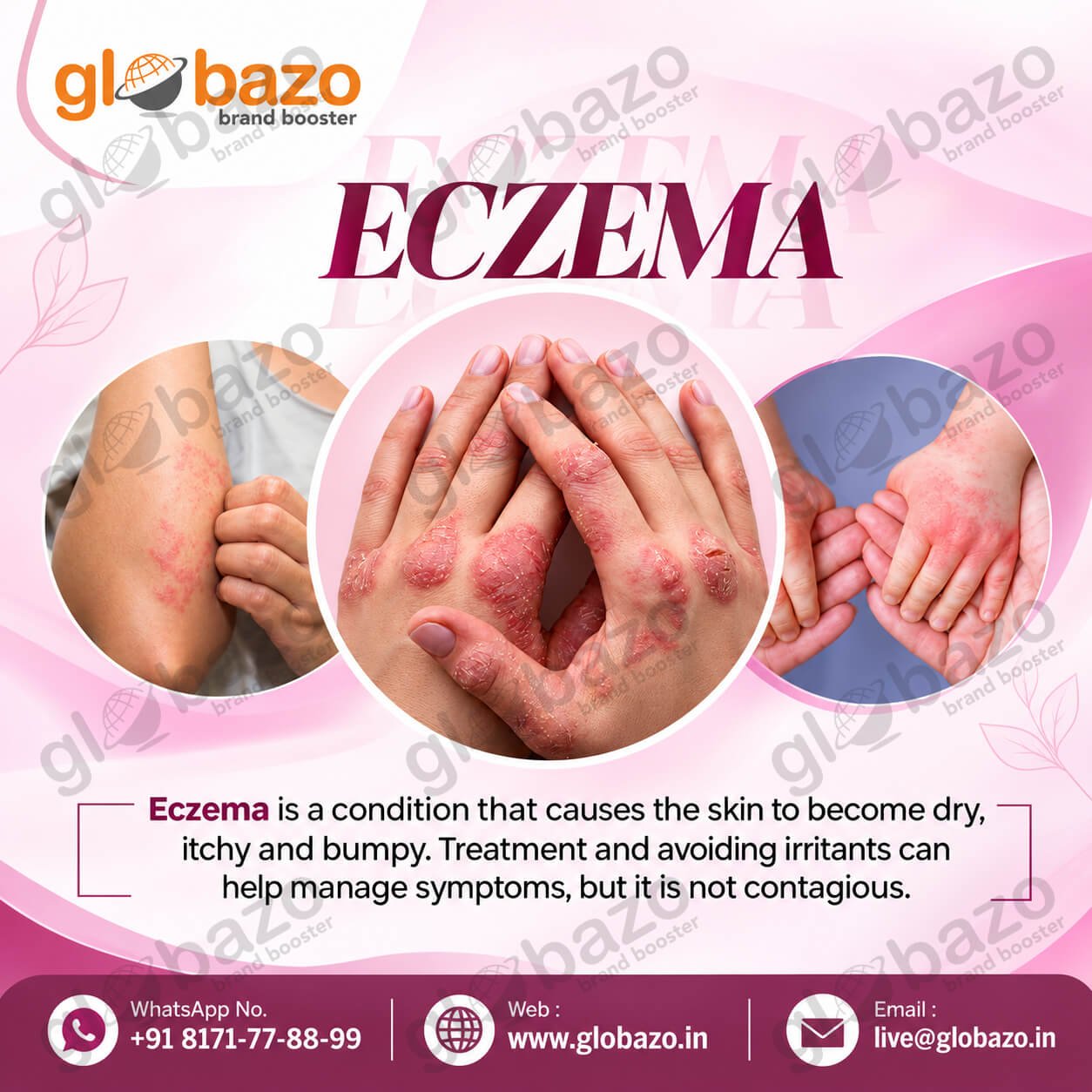Eczema Awareness (Health-399)